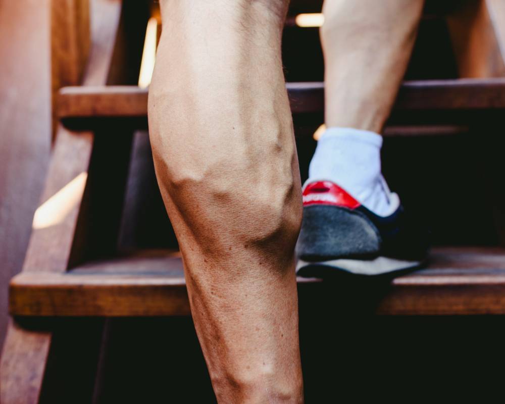 What Are Varicose and Spider Veins? Blog South Valley Vascular